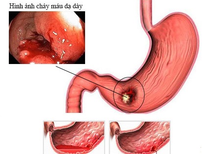 Thuốc trị đau nửa đầu, dùng sao cho an toàn?