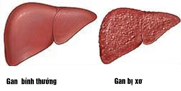 Nhiều nguyên nhân viêm gan mạn tính