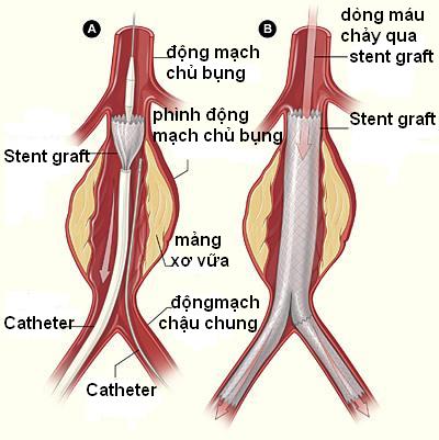 Nguy cơ tử vong do phình động mạch chủ bụng