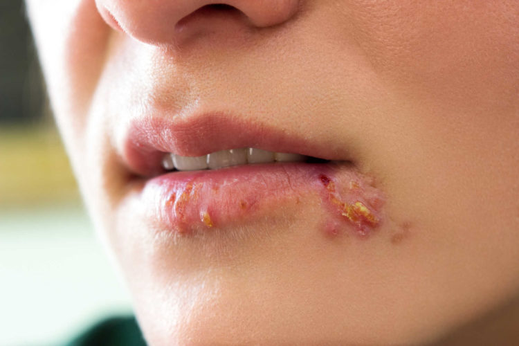 4 hướng mới điều trị Herpes trong tương lai