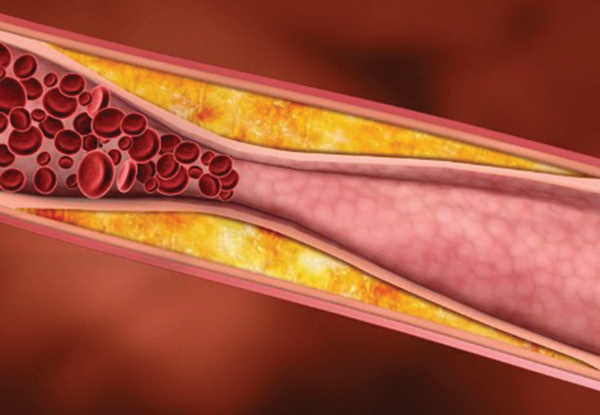 Nguy cơ gây đột quỵ do mỡ máu tăng cao
