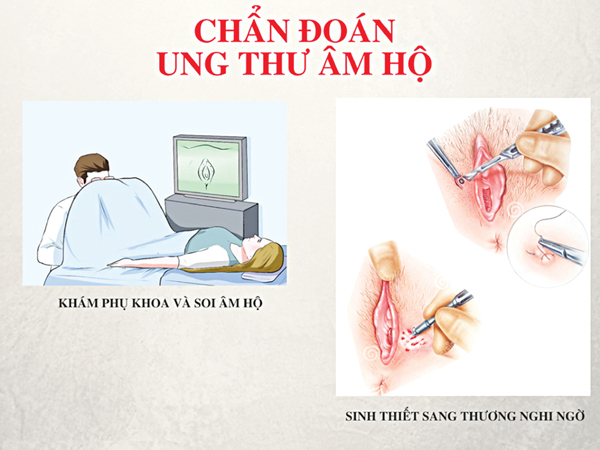 Ung thư âm hộ 