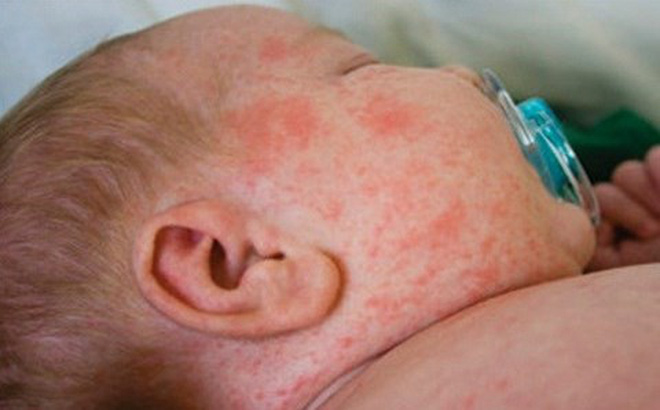 Những biến chứng nguy hiểm của sốt virus