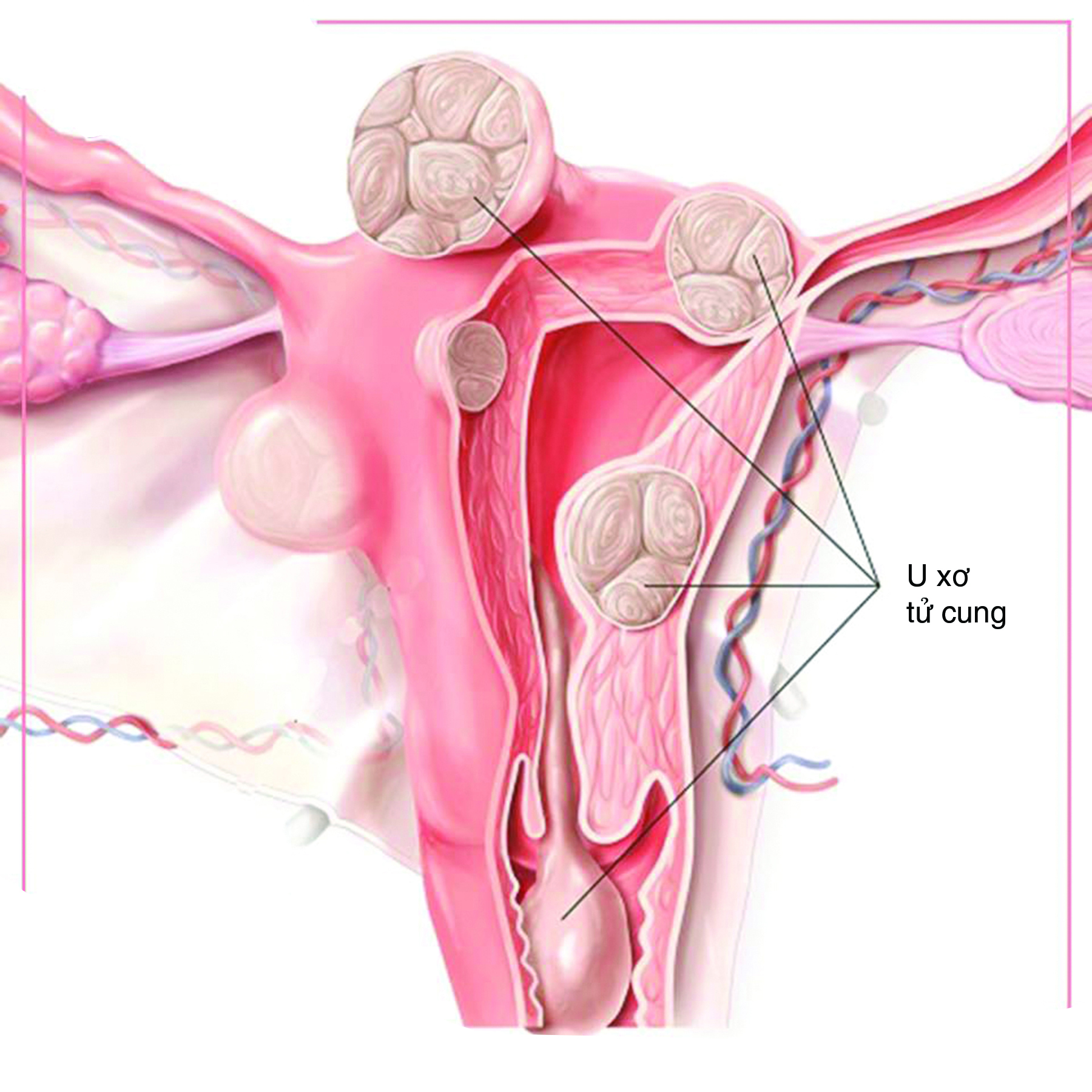 Thuốc chữa hiếm muộn do u xơ tử cung