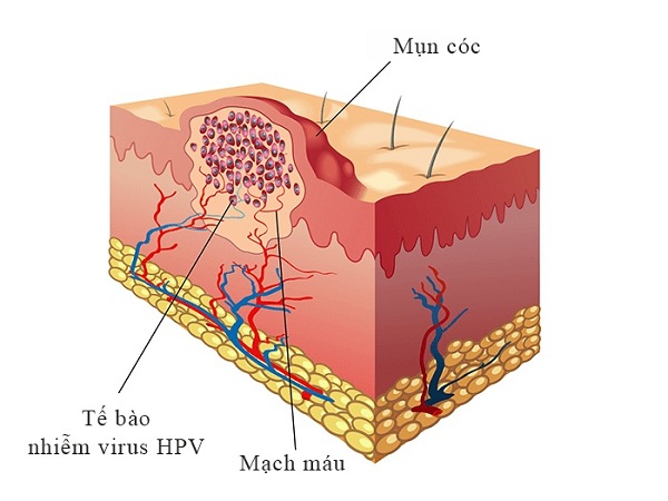 Mụn cơm (hay mụn cóc) do virut HPV gây nên