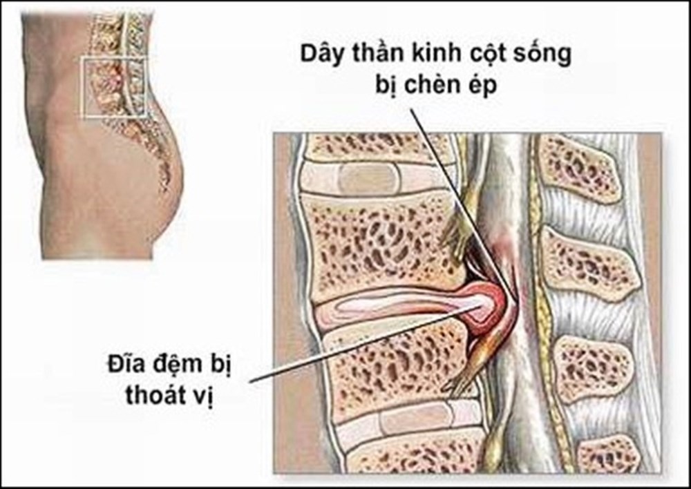 Cách trị đau thắt lưng