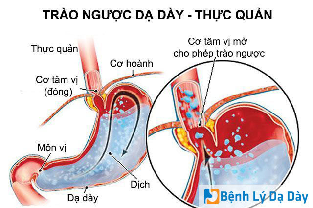 Ðông y chữa viêm thực quản trào ngược