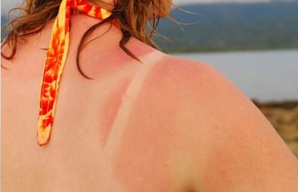 Cháy  nắng trong ngày râm mát, vì sao?