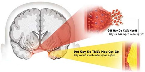 Cách phát hiện sớm đột quỵ