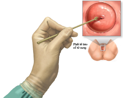 Human papilloma virus và ung thư cổ tử cung