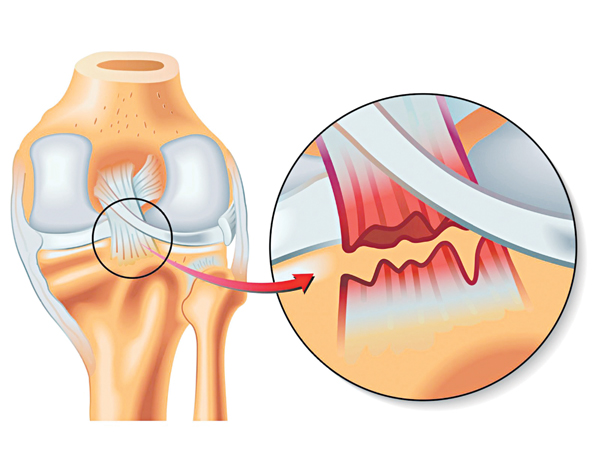 Cơn đau chấn thương khớp gối