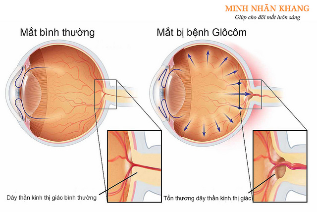 Tai biến nghiêm trọng do tự nhỏ thuốc mắt chứa corticoid