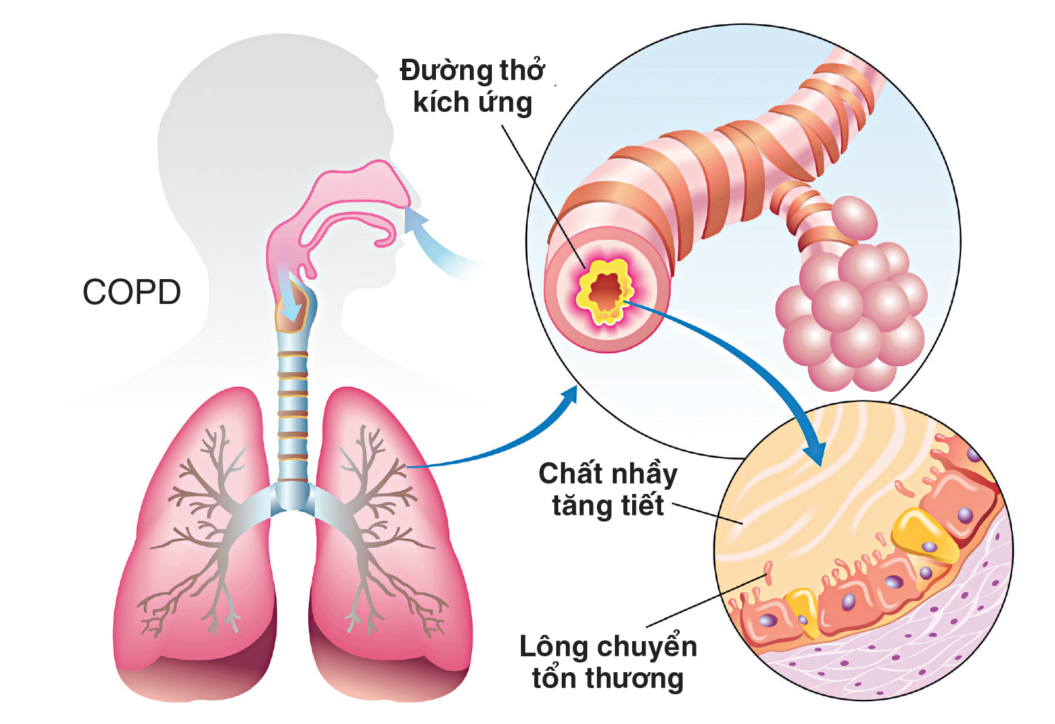 Chất nhầy ở bệnh nhân COPD có thể dẫn đến nghẹt thở khi ngủ.