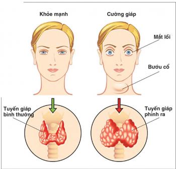 Những hệ lụy do thiếu i-ốt gây ra.