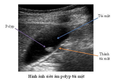 Polyp túi mật, khi nào cần điều trị?