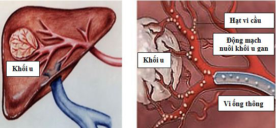 Ung thư gan trị thế nào?