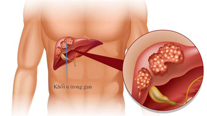 Ung thư gan trị thế nào?