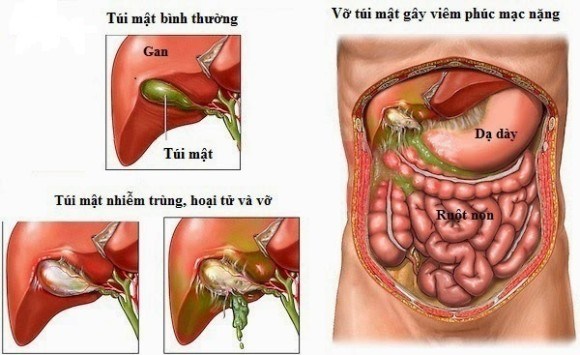 Viêm túi mật có nguy hiểm?