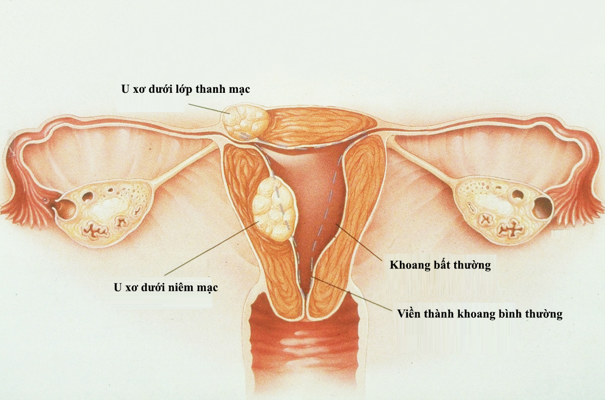 Một số bệnh phụ khoa gây vô sinh