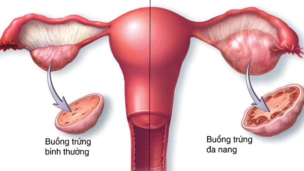 Hội chứng  buồng trứng đa nang