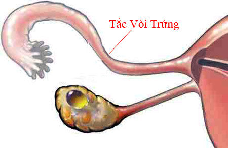 Không chủ quan với các bệnh lý ở vòi trứng