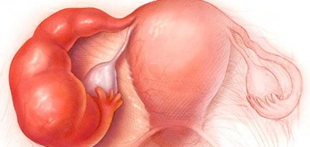 Không chủ quan với các bệnh lý ở vòi trứng