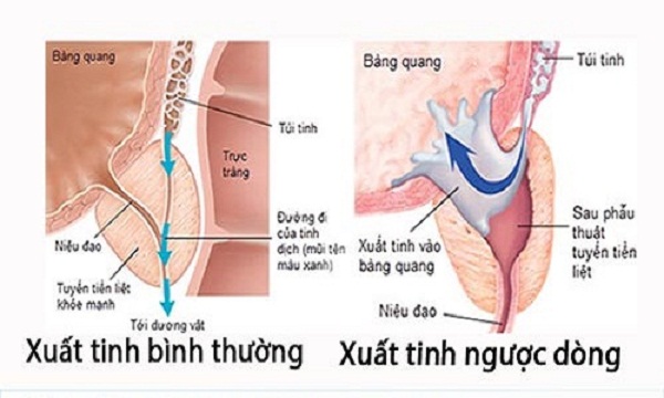 Các rối loạn xuất tinh làm ảnh hưởng tới khả năng sinh sản