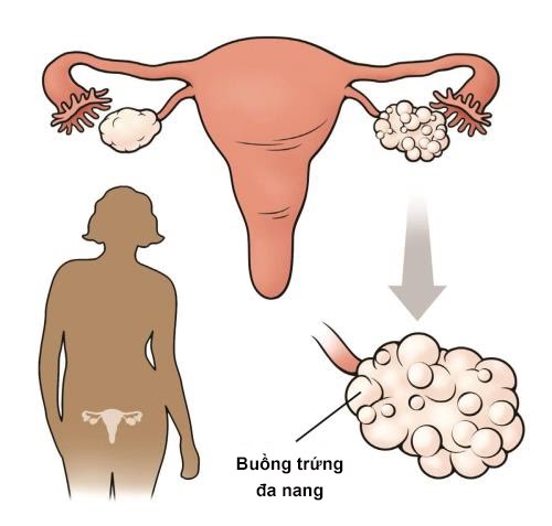 Nguy cơ vô sinh do rối loạn rụng trứng