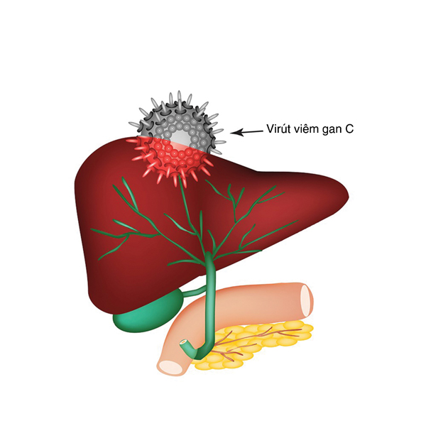 Viêm gan siêu vi C  và các biến chứng  thường gặp