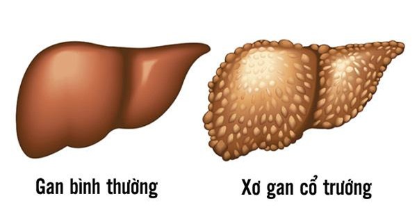 Ðông y hỗ trợ trị xơ gan cổ trướng