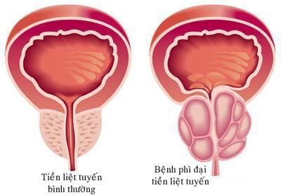 Phì đại lành tính tuyến tiền liệt