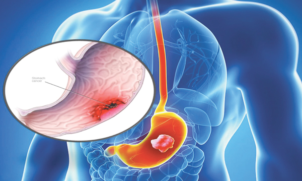 Các phương pháp mới điều trị ung thư dạ dày