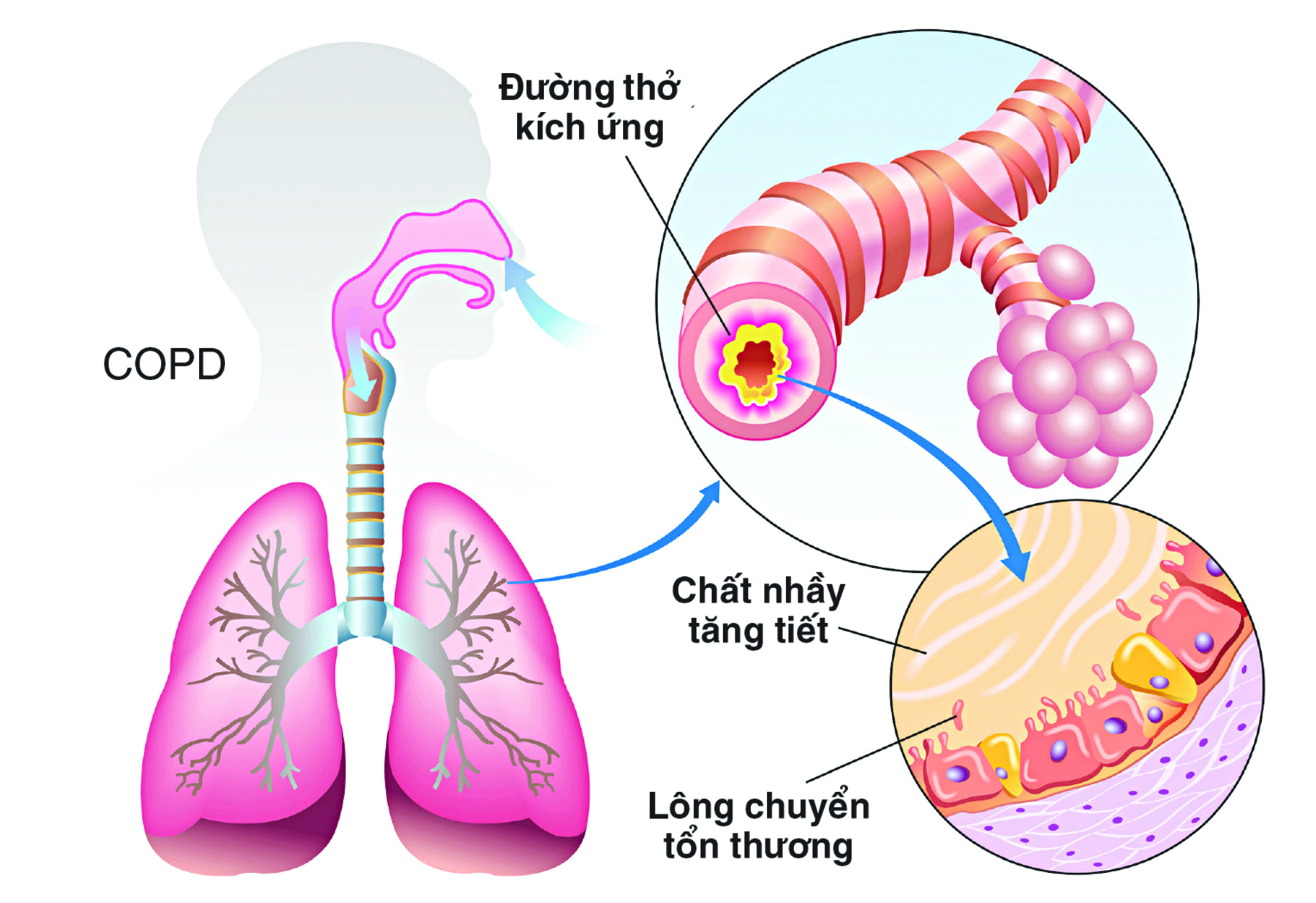 Bệnh phổi tắc nghẽn mạn tính