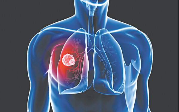 Làm sao phát hiện sớm ung thư phổi?