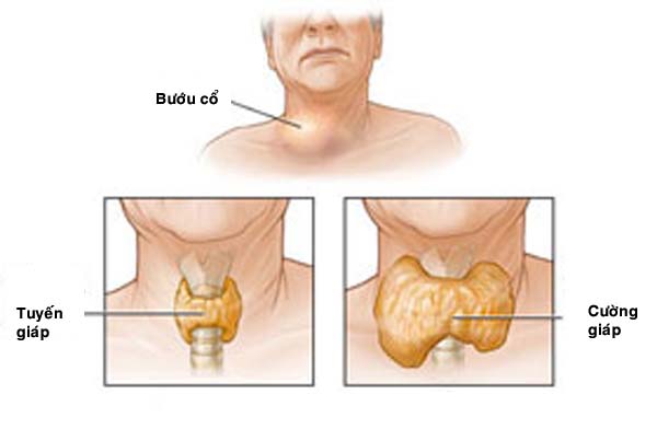 6 vấn đề tuyến giáp