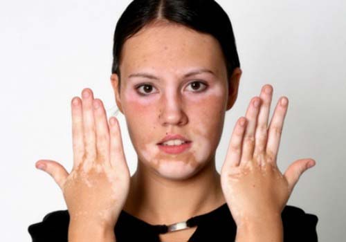 Bệnh bạch biến có thể phòng ngừa không? - Ảnh 2.