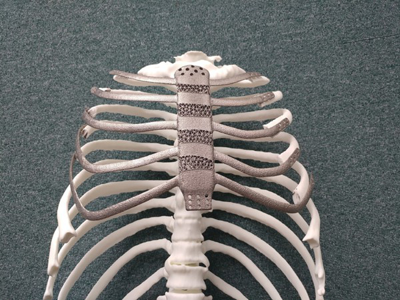 Hàn Quốc: Lần đầu tiên ghép xương ức nhân tạo bằng công nghệ in 3D
