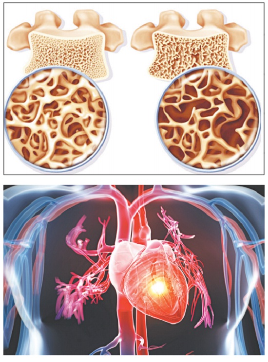 Loãng xương và bệnh lý tim mạch