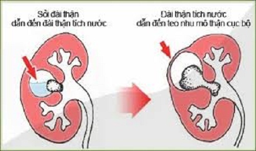 Những hệ lụy khi bị sỏi  thận - tiết niệu