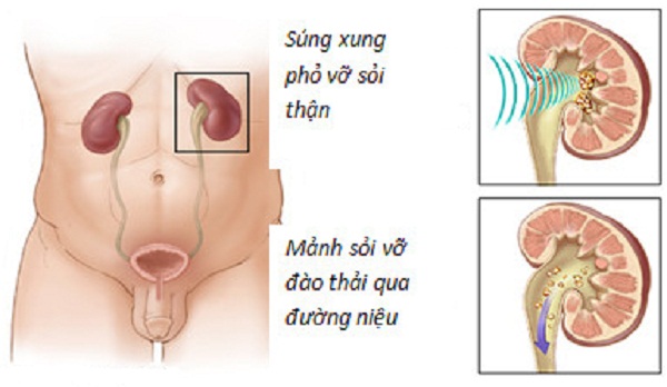 Những hệ lụy khi bị sỏi  thận - tiết niệu