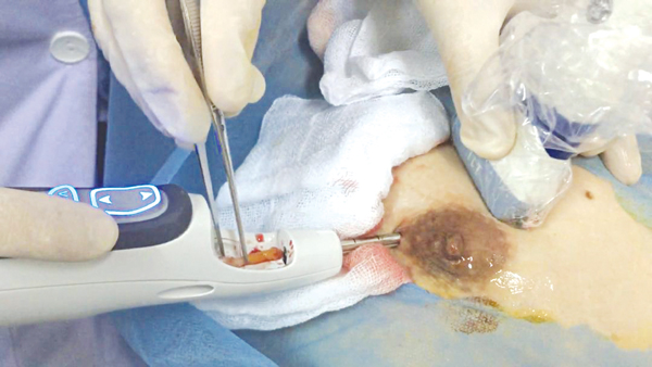 Kỹ thuật sinh thiết khối u có hỗ trợ hút chân không