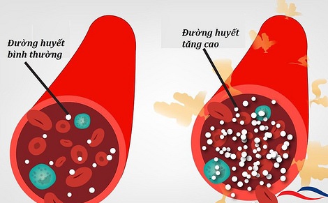 Khi đường huyết không ổn định