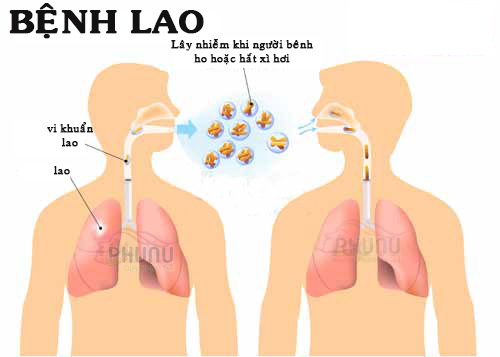 Nâng cao nhận thức về phòng, chống lao trong cộng đồng