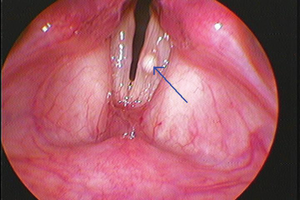 Khàn tiếng kéo dài, nên kiểm tra polyp dây thanh