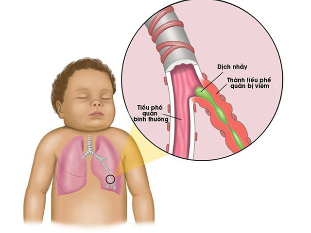 Vì sao trẻ nhỏ hay bị viêm tiểu phế quản?
