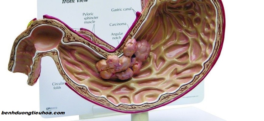 Polyp dạ dày có trở thành ung thư?
