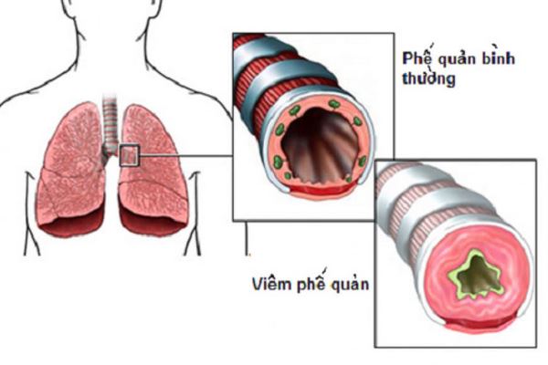 Cách ứng phó với bệnh viêm phế quản