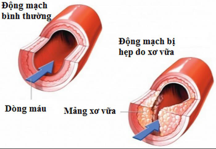 Rối loạn cương dương 