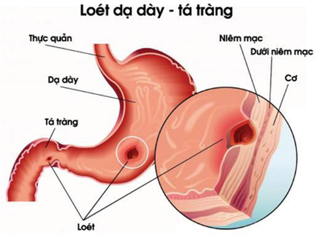 Thảo dược trị viêm dạ dày tá tràng