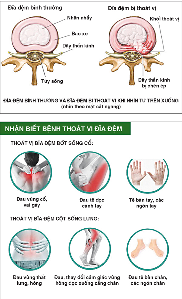 Thoát vị đĩa đệm